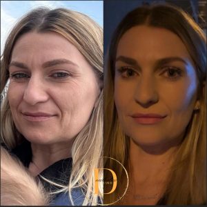 Sculptra Gradual, long-term collagen restoration Sculptra is designed to rebuild lost collagen over time, making it ideal for full-face rejuvenation and structural improvement. Where it can be used: • cheeks and mid-face • temples • jawline • lower face • skin laxity areas What it does: Sculptra works deep within the skin to gradually restore volume and improve skin quality. Instead of instant results, the skin becomes firmer, smoother and more structured over time. Treatment plan: • usually performed as a course of 2–3 sessions • sessions spaced around 4–6 weeks apart When will you see results: • initial improvement may be seen within weeks • full results develop over 2–3 months How long does it last: • results can last up to 2 years or more Sculptra is ideal for clients who want a natural transformation without obvious signs of treatment.