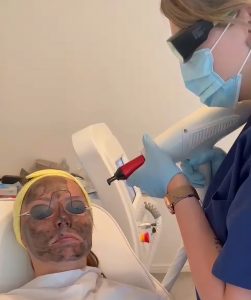 carbon facial