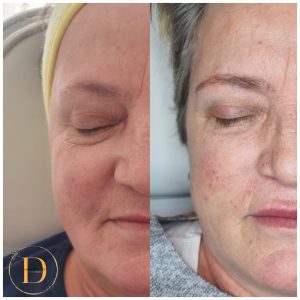 radiesse warrington biostimulators warrington