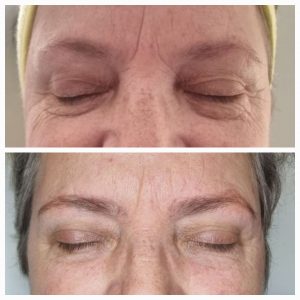 under eye treatment skin booster treatment warrington polynucleotide treatment warrington biostimulator treatment warrington
