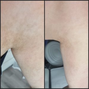 pigmentation removal warrington