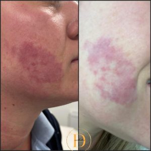 birthmark removal warrington