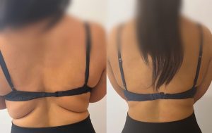 radiofrequency body contouring Warrington cavitation fat reduction Warrington ultrasound body contouring Warrington RF skin tightening Warrington