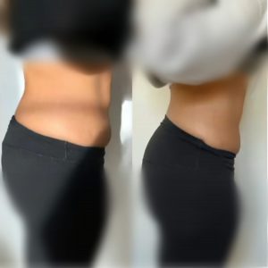 radiofrequency body contouring Warrington cavitation fat reduction Warrington ultrasound body contouring Warrington RF skin tightening Warrington