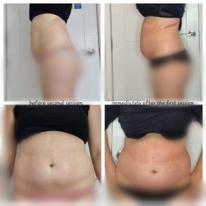 radiofrequency body contouring Warrington cavitation fat reduction Warrington ultrasound body contouring Warrington RF skin tightening Warringtontreatments