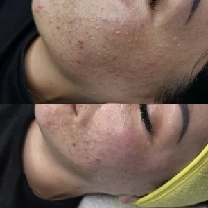 facial treatments warrington