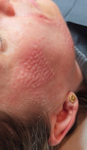 mesotherapy warrington