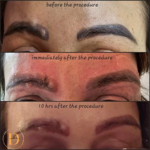 semi permanent makeup removal Warrington