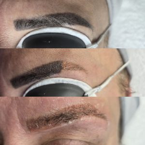 laser eyebrow tattoo removal results semi permanent makeup removal Warrington