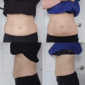 radiofrequency body contouring Warrington