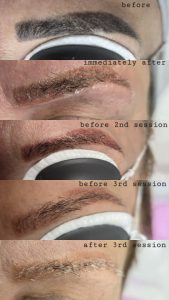 eyebrow tattoo removal Warrington before and after SPMU removal Warrington laser eyebrow tattoo removal results semi permanent makeup removal Warrington