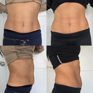 fat dissolving injection aqualyx warrington radiofrequency body contouring Warrington