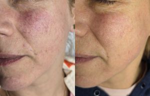 spider vein treatment Warrington laser vein removal Warrington sclerotherapy treatment Warrington thread vein removal before after Warrington