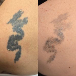 laser tattoo removal treatment Warrington
