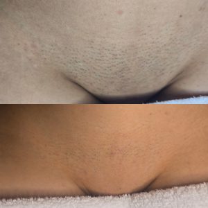 laser hair removal Warrington before and after