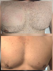 laser hair removal warrington