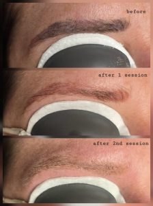 eyebrow tattoo removal Warrington before and after SPMU removal Warrington laser eyebrow tattoo removal results semi permanent makeup removal Warrington