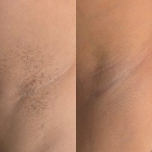 laser hair removal results Warrington