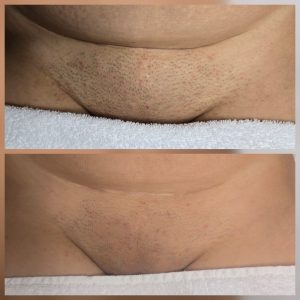 Nd:YAG laser hair removal Warrington