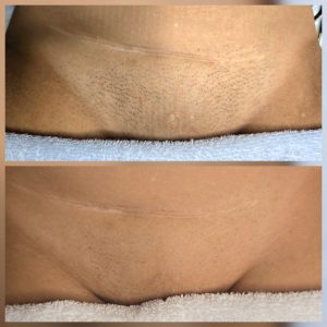medical grade laser hair removal Warrington