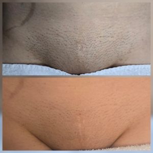 laser hair removal results Warrington