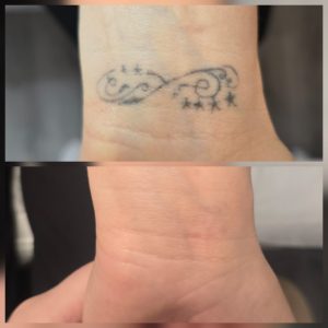 tattoo removal results after sessions Warrington