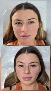 dermal fillers cheek filler before after Warrington jawline filler treatment Warrington nose filler non surgical rhinoplasty Warrington tear trough filler Warrington