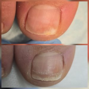 fungal nail treatment warrington toenail fungus before and after Warrington