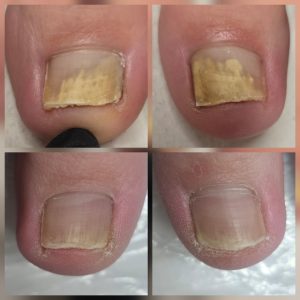 fungal nail treatment Warrington