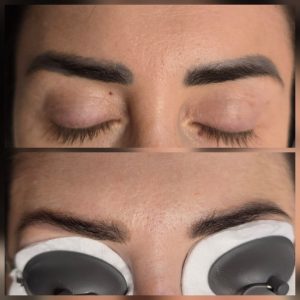 eyebrow tattoo removal Warrington before and after SPMU removal Warrington laser eyebrow tattoo removal results semi permanent makeup removal Warrington