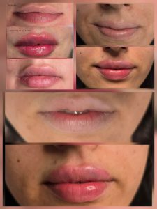 lip correction warrington lip filler lip filler warrington
