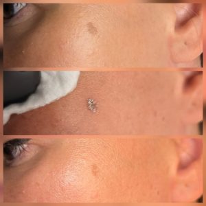 pigmentation removal warrington