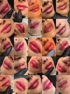russian lip filler Warrington before and after lip fillers warrington