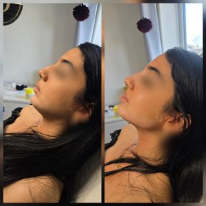 cheek filler before after Warrington jawline filler treatment Warrington nose filler non surgical rhinoplasty Warrington tear trough filler Warrington